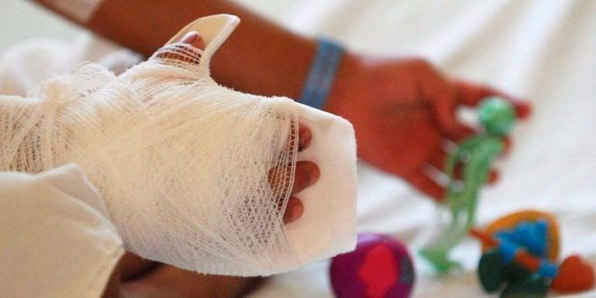 14 quemados con pólvora es el reporte que hasta la fecha registra el departamento del Valle en lo que ha transcurrido el mes decembrino, ocho de ellos son niños.