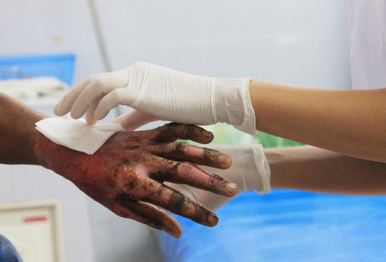 Cauca: ya se confirman los primeros casos de quemados con pólvora