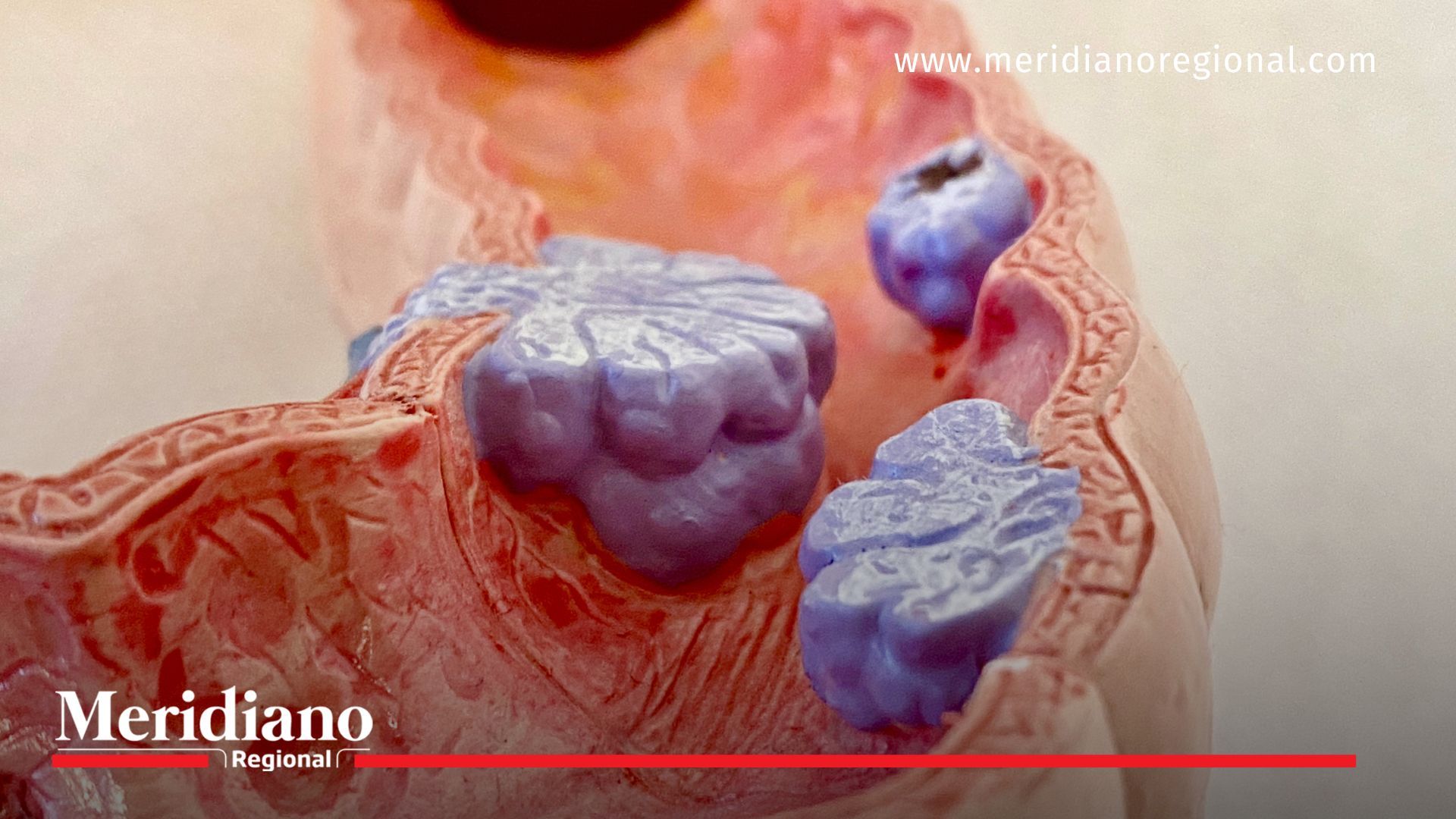 FDA aprueba test de sangre para cáncer de colon: ¿Revolución en detección temprana?
