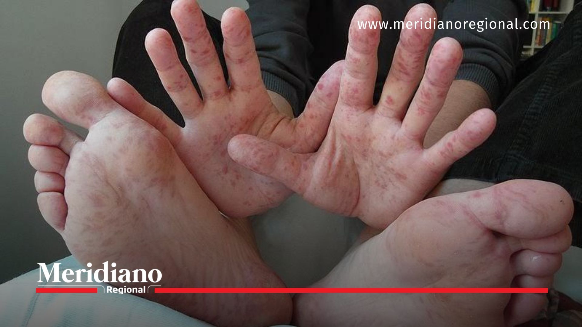Popayán en alerta por brote del virus Manos, Pies y Boca en escuelas. Niños presentan síntomas. Secretaría de Salud emite medidas preventivas.