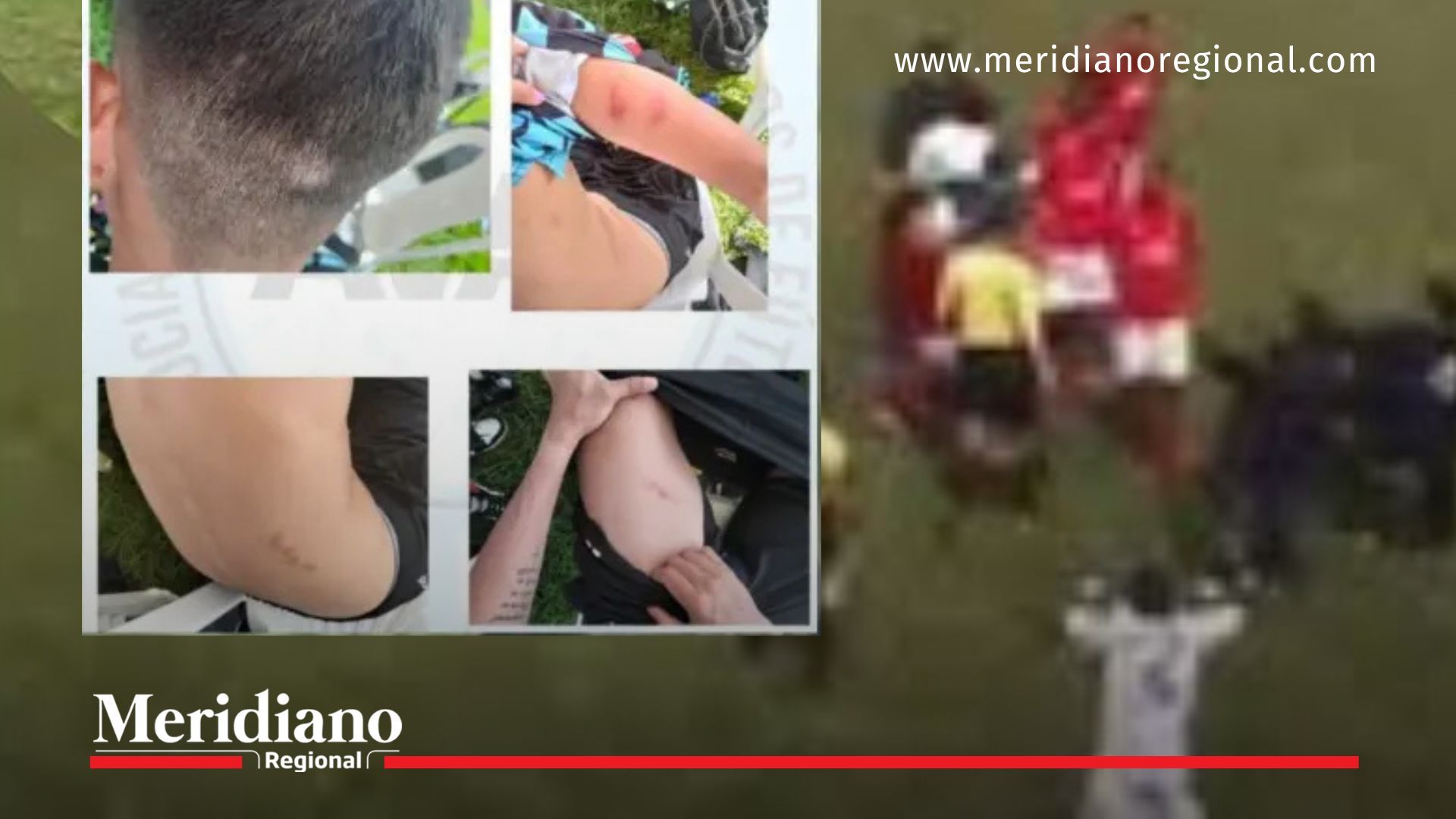 Heridas del árbitro Fernando Velásquez Amador tras agresión en partido sub-17 del Torneo de las Américas en Cali.