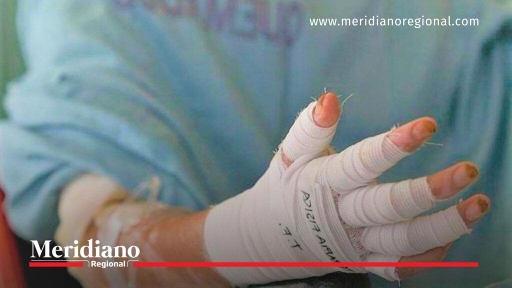 Quemados por pólvora en el Valle del Cauca afectan a menores - Meridiano Regional Menor de edad con quemadura por pólvora en el Valle del Cauca