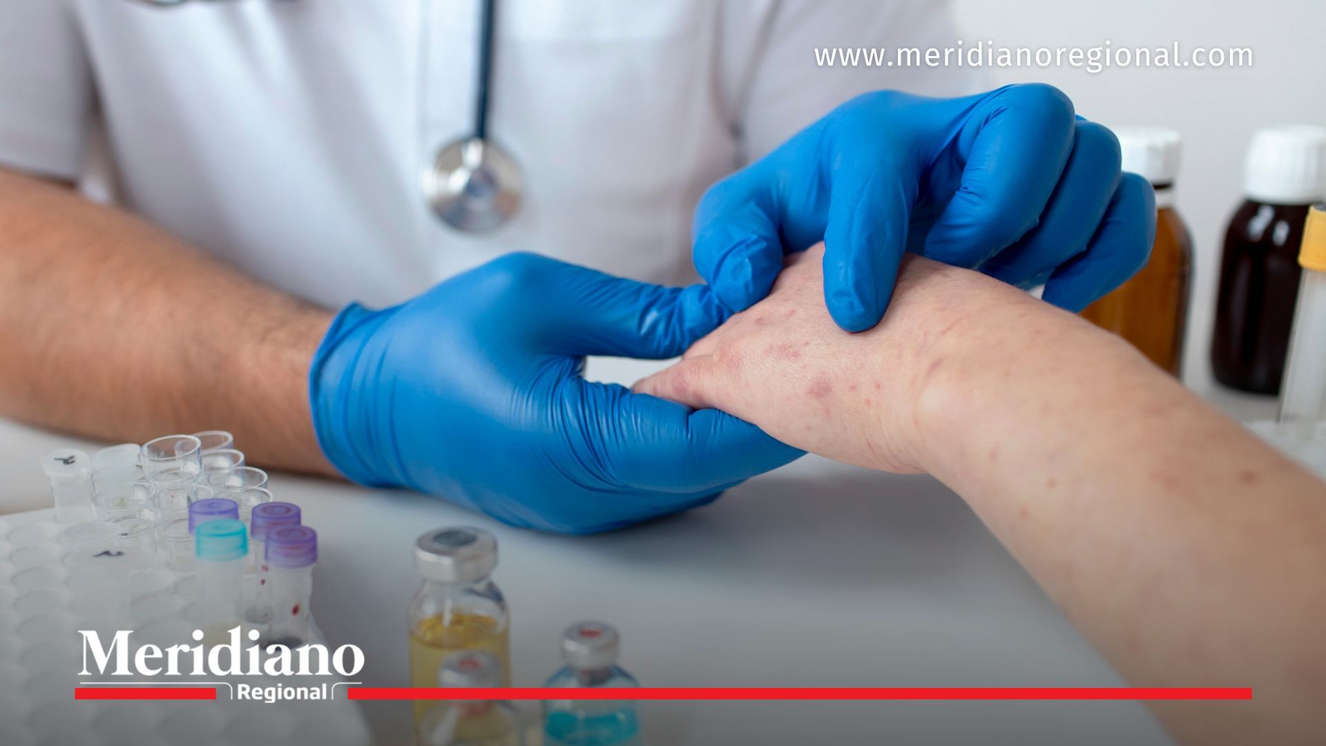 Personal de salud evalúa erupciones cutáneas asociadas al sarampión y refuerza la importancia de la vacunación.