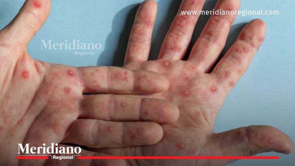 Manos con lesiones cutáneas visibles asociadas a la mpox, mostrando erupciones en la piel características de esta enfermedad viral.